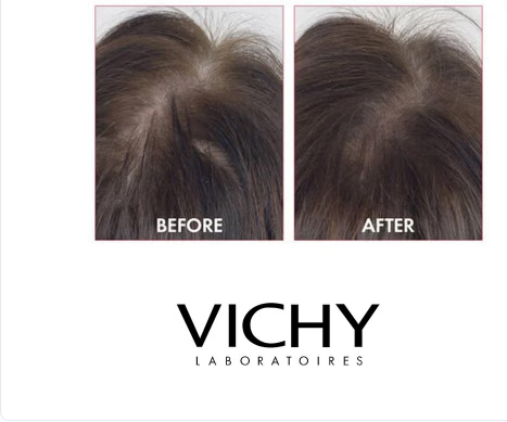 Vichy Dercos Aminexil Clinical 5 Anti-Hair Fall Treatment For Men, Pack of 6ml x 21's